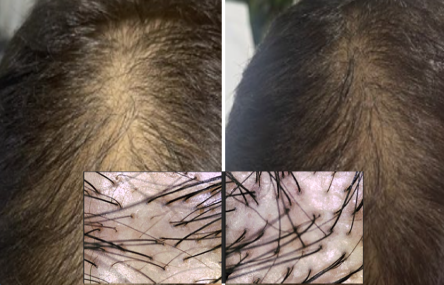 Exosomes for hair growth female baldness facelove