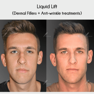 Male dermal filler liquid lift chin jawline cheek