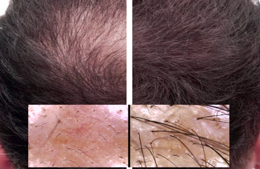 Exosomes for hair growth male baldness facelove