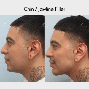 Male dermal filler chin jawline facelove
