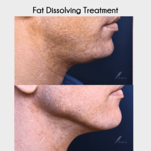 Male fat dissolving double chin treatment facelove