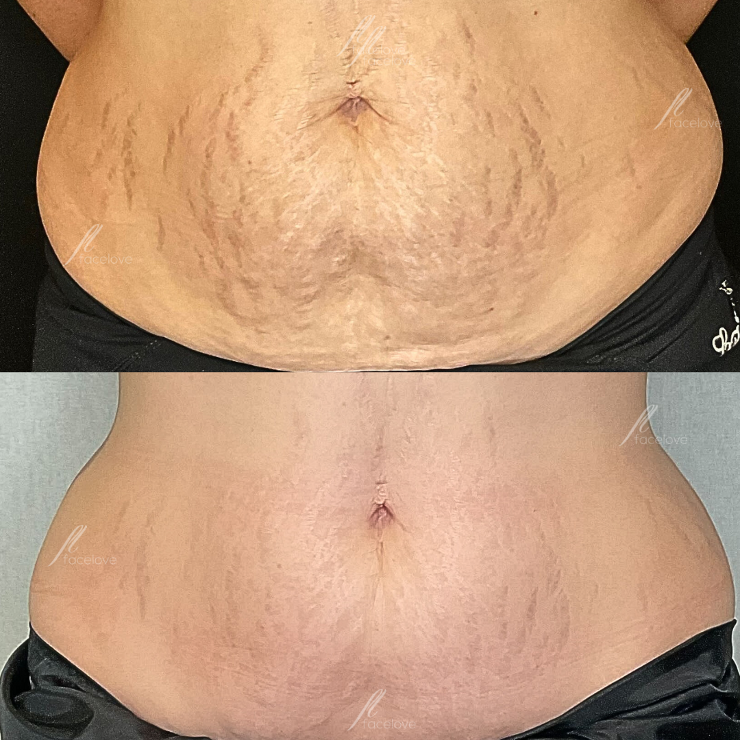Before and after of stretchmark treatment
