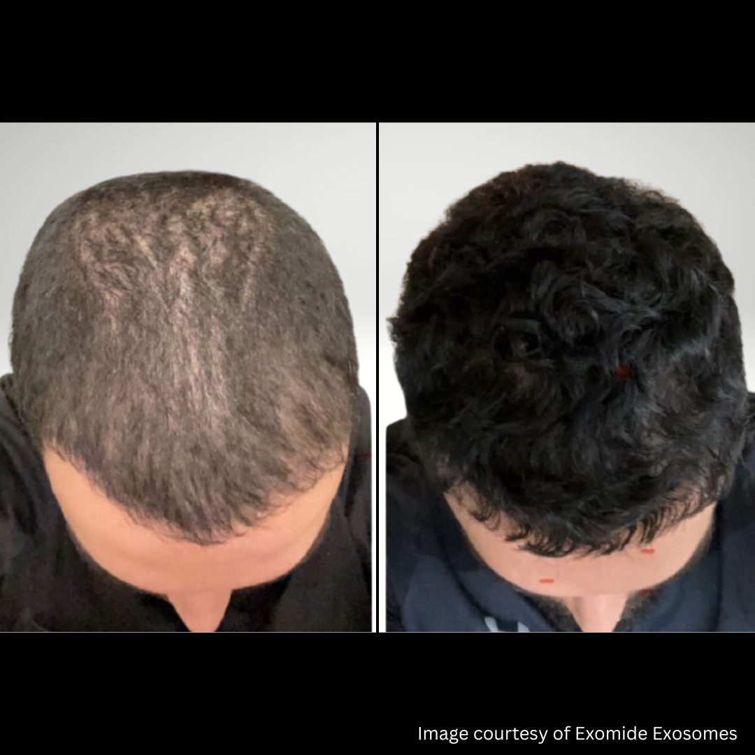 Exosomes for hair growth