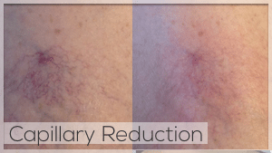 Capillary Reduction Facelove Melbourne