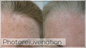 Photo Rejuvenation Facelove Melbourne