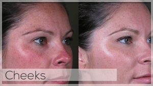 Cheek filler Treatment Facelove Melbourne
