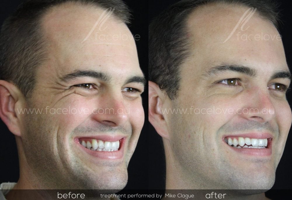 crows feet male treatment before after @ facelove