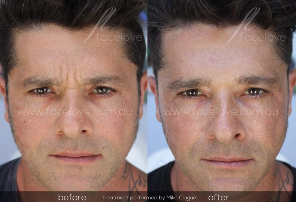 frown line anti wrinkle treatment male before and after facelove