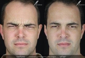 Anti-wrinkle Injections Melbourne - facelove