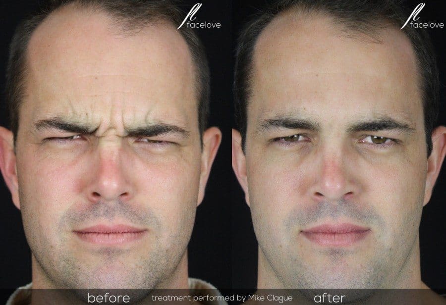 frown lines anti-wrinkle treatment male @ facelove - Facelove