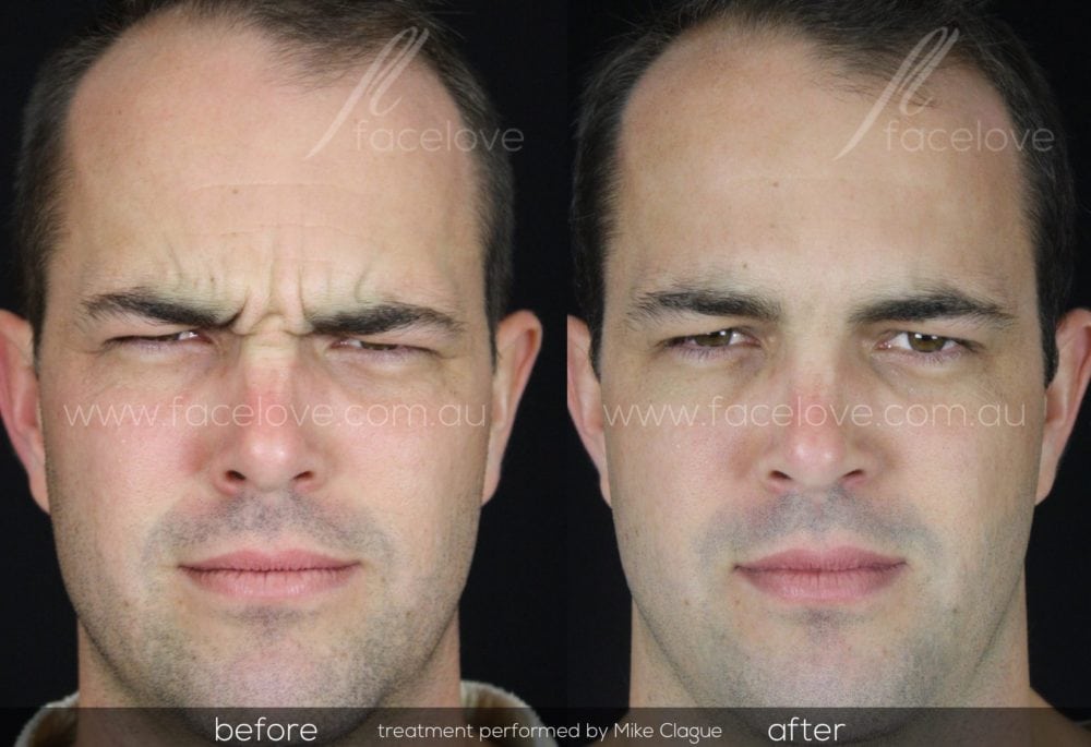 frown lines anti-wrinkle treatment male @ facelove