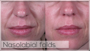 Nasolabial folds treatment Facelove Melbourne