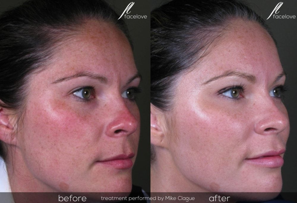 Cheek Filler Before And After Facelove Facelove 