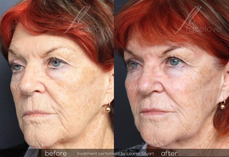 Dermal filler treatment for older women Facelove