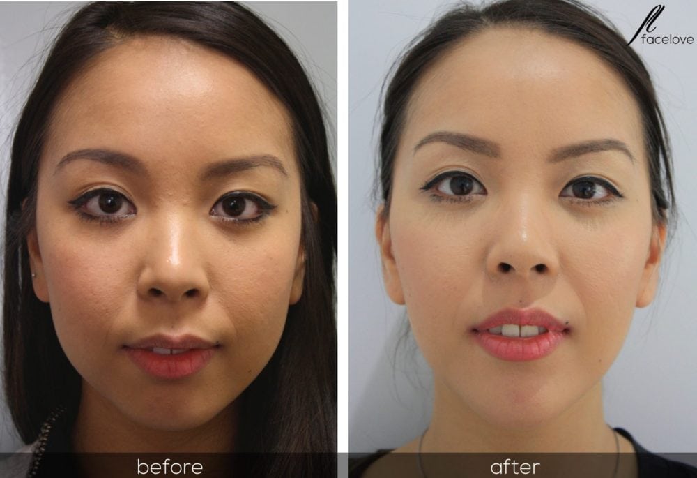 facial reshaping before and after at facelove - Facelove