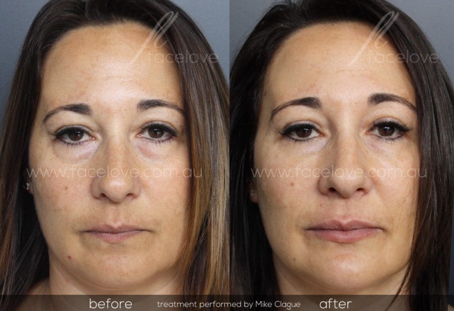 How Melbourne Residents can get rid of Bags and Dark Circles under the Eyes with Dermal Fillers