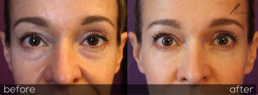 tear trough before and after treatment facelove - Facelove