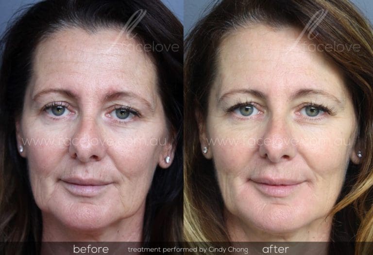 Lines and Jowls Treatment Facelove St Kilda, Melbourne