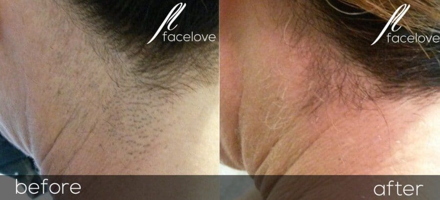 Laser Hair Reduction - Facelove