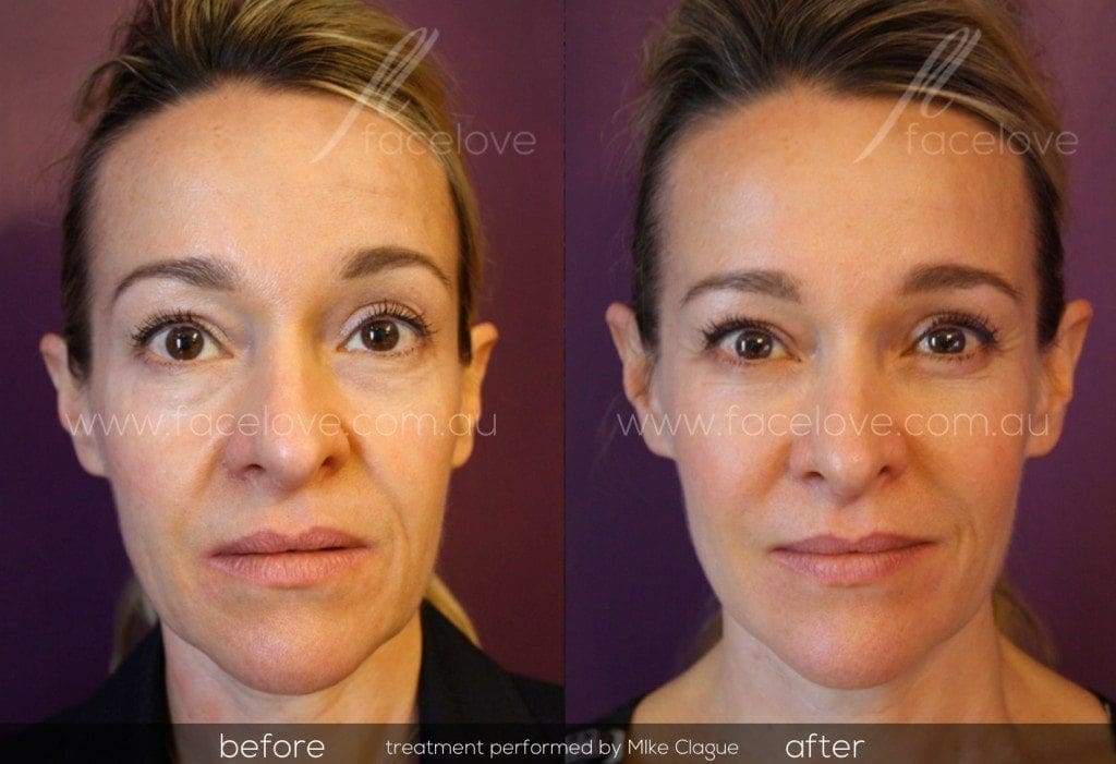 face slimming mask does it work before and after