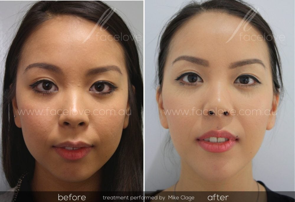 Facial Slimming Dermal Filler at Linda Reed blog