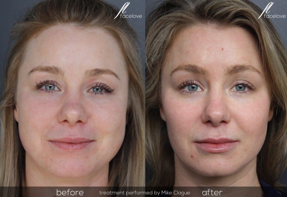 facial reshaping treatment before and after facelove Facelove