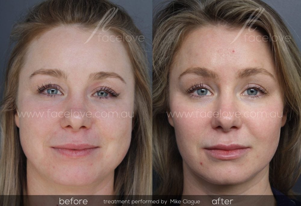 face slimming mask before and after you have