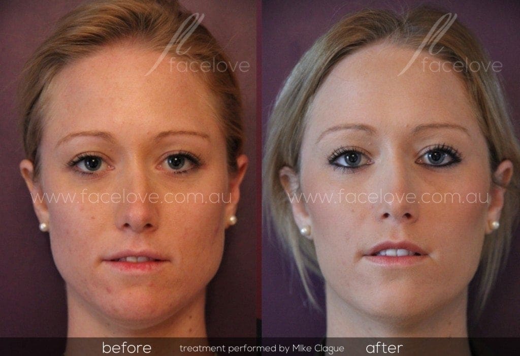 face slimming mask does it work before and after