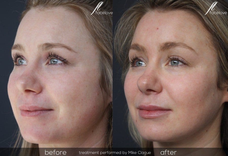 Facial Slimming Before And After Mike Clague Facelove - Facelove