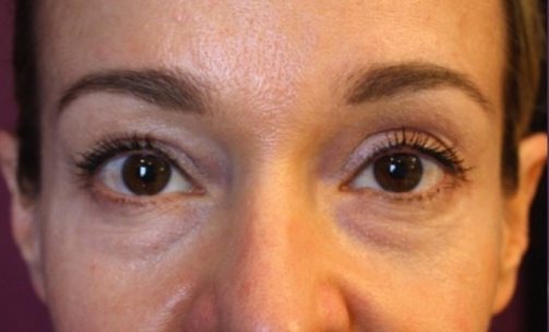 5 Ways to Reduce Dark Circles under the Eyes