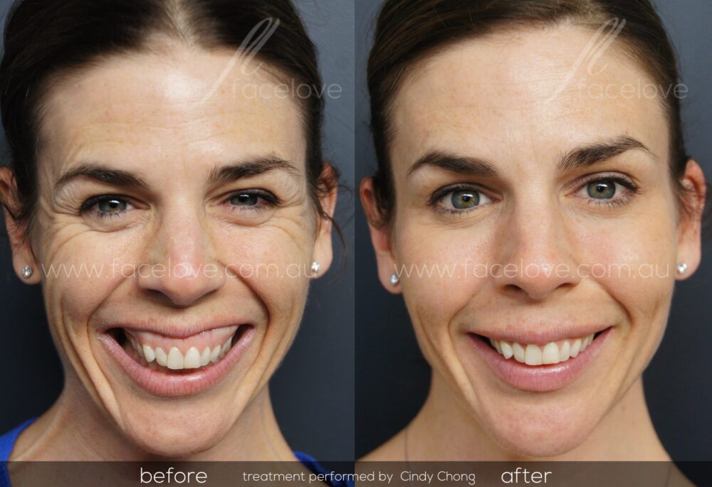 Anti-wrinkle gummy smile treatment before and after