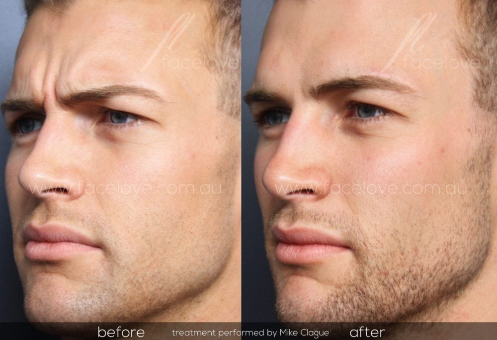 anti-wrinkle injections melbourne for men