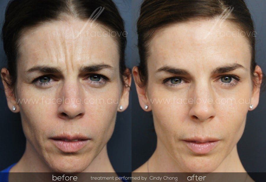 Five Benefits of Anti-Wrinkle Injections at Melbourne-based Facelove
