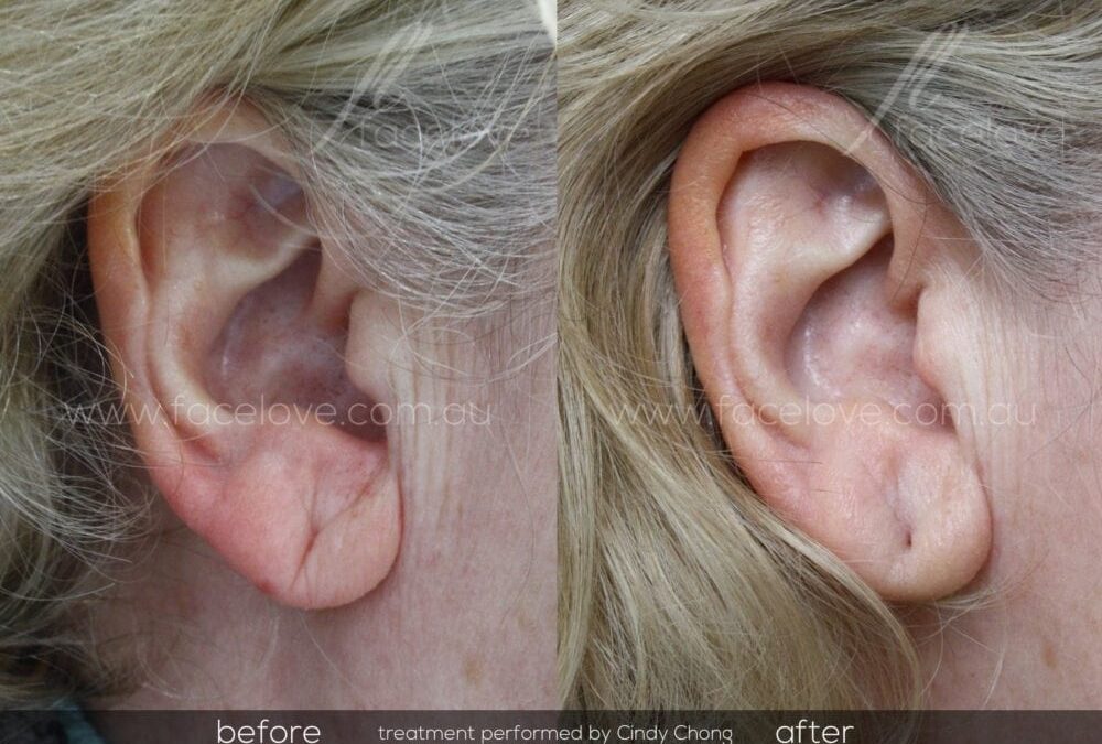 Ear lobe rejuvenation dermal filler treatment before and after Facelove