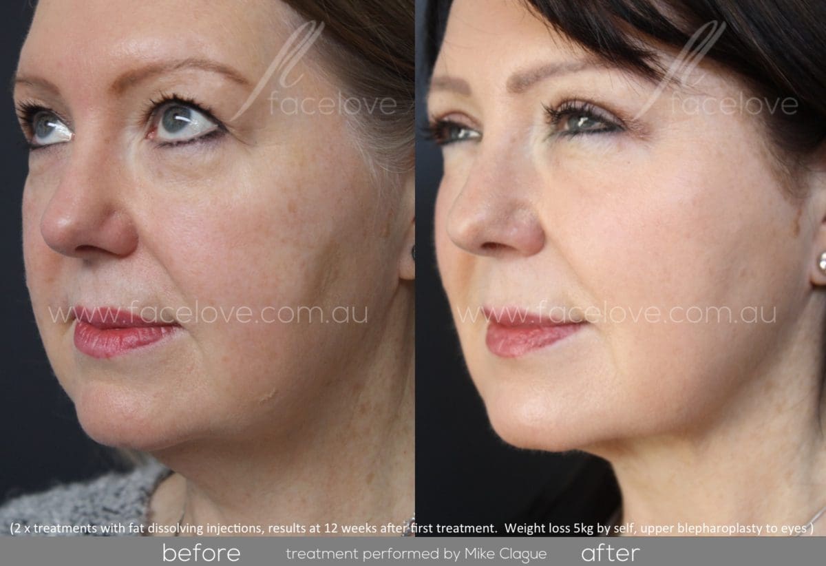 Double chin fat dissolving injections Facelove Medispa St Kilda