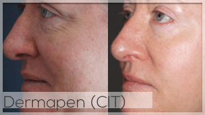 Dermapen Treatment