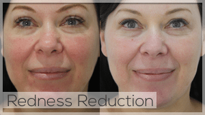 Redness Reduction