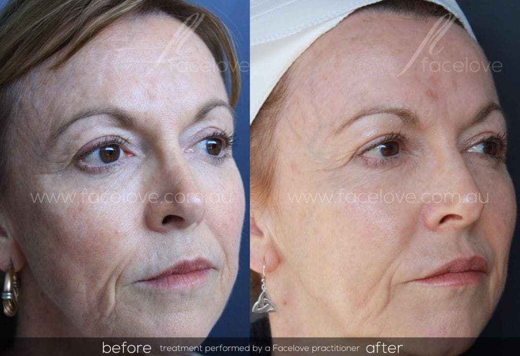 Skin Tightening with The Secret MicroNeedle Fractional RF Facelove St Kilda, Melbourne