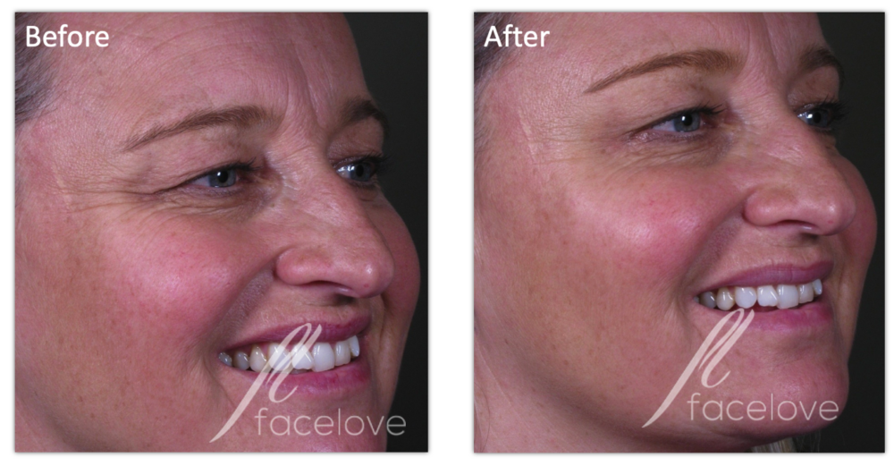 Natural Looking anti-wrinkle injections
