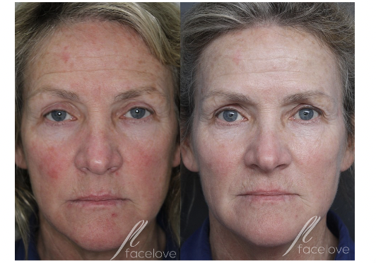 Natural Looking anti-wrinkle injections