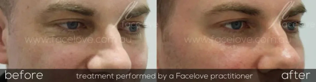 Before and after CO₂ laser resurfacing treatment
