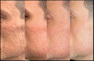 Skin Needling Before and After Facelove Medispa St Kilda