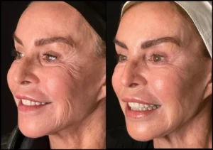 CO2 Secret RF Microneedling Before and After Facelove Medispa St Kilda 4