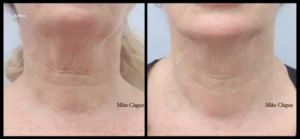 CO2 Before and Afters Facelove Medispa