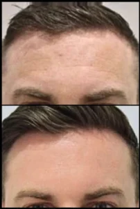CO2 Fractional Laser Before and After Facelove Medispa St Kilda 6