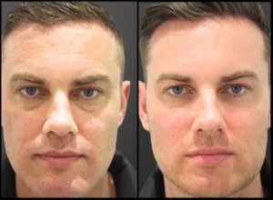 CO2 Fractional Laser Before and After Facelove Medispa St Kilda 5