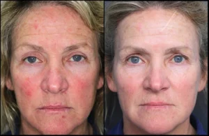 IPL Skin Treatment Before and After Facelove Medispa St Kilda 7