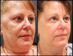 CO2 Laser Resurfacing – Fraxis Duo Before and Afters