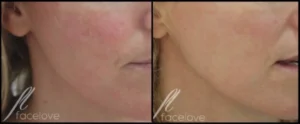 IPL Skin Treatment Before and After Facelove Medispa St Kilda 11