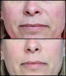 IPL Skin Treatment Before and After Facelove Medispa St Kilda